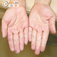 嚴重的「主婦手」患者雙手長滿水泡，皮膚亦有龜裂情況。
