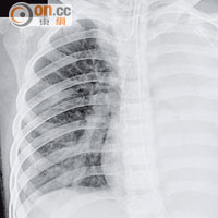感染肺炎支原體可引致肺炎，病人一邊肺因肺炎變白。