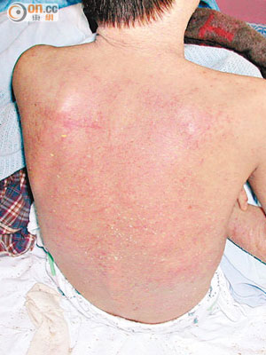 嚴重濕疹可引致紅皮症，病人皮膚會出現嚴重感染。