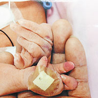 女嬰手指變形。（受訪者提供圖片）
