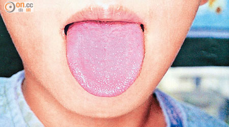 猩紅熱患者可能呈「草莓舌」。
