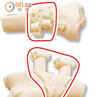 骨模（紅圈）標示骨骼切割及接駁位置，有助提高手術準確度。