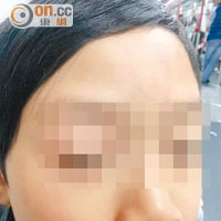 陳太的兒子戴上面具半小時後，感到痕癢無比，面上更出現紅疹。（相片由讀者提供）
