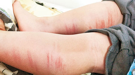 男童雙腿留有多條懷疑被藤條打傷造成的紅痕。（互聯網圖片）