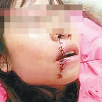 一名女傷者被重創，嘴臉需縫上多針。（互聯網圖片）
