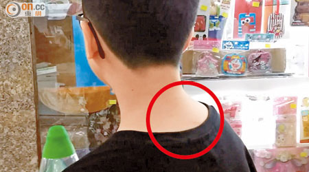男童的後頸有疑被抓傷痕（紅圈示）。（趙瑞麟攝）