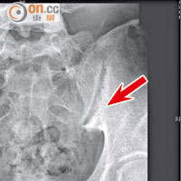 X光片顯示二十一歲患者的盆骨關節位置（箭嘴示）有異常。