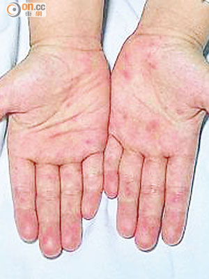 腸病毒可引起手足口病，患者手腳會出現紅疹。（資料圖片）