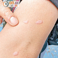 耕地一帶蚊患嚴重，記者被蚊狂叮，手臂多處紅腫。