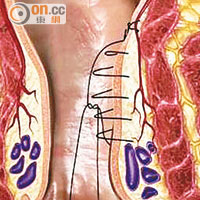 「痔動脈結紮術」以微創方式，從而拉起下垂的痔組織。（由受訪者提供）