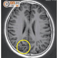 正子電腦斷層造影顯示患者右方視覺大腦皮層（圓圈示）發展異常。