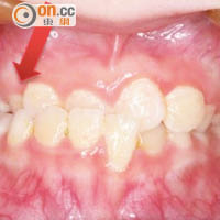 前牙錯咬指牙齒咬合時，下顎牙會蓋過上顎牙。