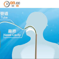 喉管將處理過的「糞水」經鼻孔移植至小腸。