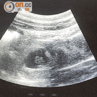 9月22日 <br>超聲波顯示，盈盈胎兒已停止發育，胎兒結構已不成形。