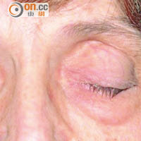 眼皮下垂是重症肌無力早期徵狀。