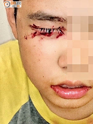 小六畢業男生偉仔於今年七月中旬在校內撞爆右眼，需縫上三十多針。（資料圖片）