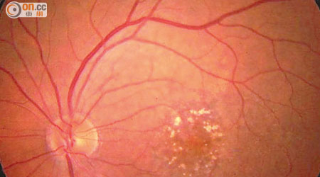 黃斑病變可損害分辨顏色的視覺神經。（資料圖片）