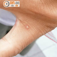 遭紅火蟻咬傷後，傷口即時形成水泡及膿瘡。（受訪者提供）