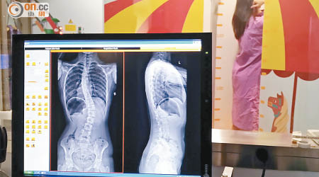 EOS Ⅹ光醫學影像系統半小時內得出患者脊柱側彎數據，有助醫生判斷病情。（鍾君容攝）