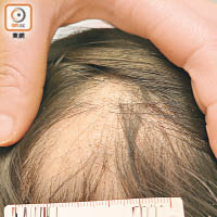 斑禿多出現在頭頂位置，脫髮後的頭皮平滑。