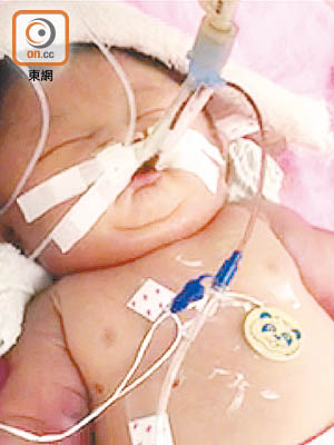 琳琳出世後因呼吸、腦部等問題，轉至新生嬰兒深切治療部，滿身插滿儀器，父母心痛不已。（受訪者提供）