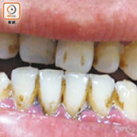 C先生術後重新刷牙，牙漬明顯消退。