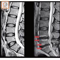 圖左為正常脊骨，圖右的紅色箭嘴顯示Modic異變的脊椎椎骨體變化，可憑椎體數量得知腰痛嚴重程度。