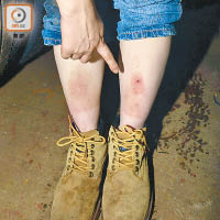 華姐雙腳曾在燒焊時被燙傷。