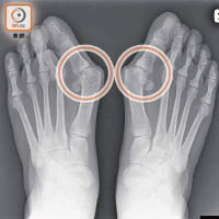 拇趾外翻是因足部軟組織分布不均，令連接拇趾與腳掌蹠骨（圓圈示）向外傾斜。