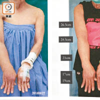 何女士一四年接受淋巴移植手術，八個月後右臂腫脹消退，回復力氣。圖左為術前情況，圖右為術後八個月。（受訪者提供）