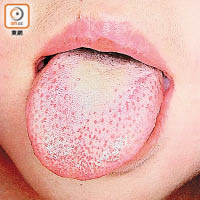 猩紅熱徵狀之一，是舌頭變成「士多啤梨脷」。