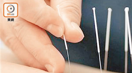 英國研究指出，為人工受孕的婦女針灸，或可提高受孕機會。（資料圖片）