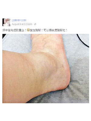 李小姐稱在佐敦遇上「真大肚婆搶手袋黨」，更被推出馬路導致腳部受傷。（李小姐facebook）