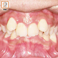牙齒不齊增加食物殘渣留在牙縫，引致牙肉發炎的機會。（資料圖片）