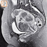 磁力共振圖見，子宮內四個深黑陰影是肌瘤。（受訪者提供）