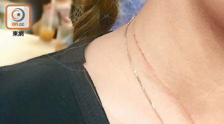 少女頸上留下一條傷痕。