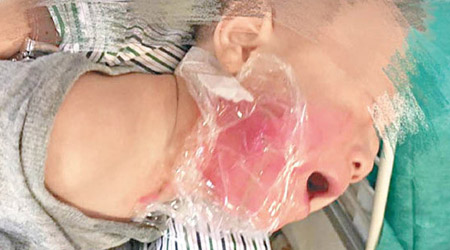 BB被滾水淥至面頰及頸部紅腫，用保鮮紙保護防感染。（互聯網圖片）