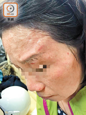 台北市議員顏若芳的母親，在台北寧夏夜市被航拍機砸傷眼險盲。（資料圖片）