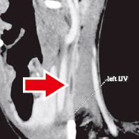 電腦掃描顯示病人左頸靜脈（箭嘴示）有阻塞。（香港醫學雜誌圖片）