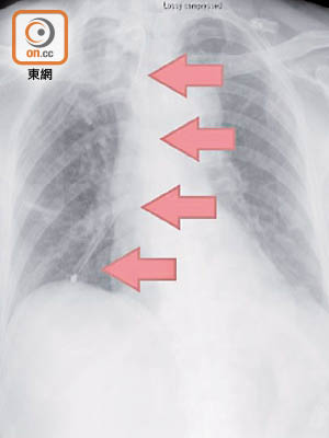一條折斷後長達廿三厘米長的鼻胃管（箭咀示）遺留於病人的肺部，翌日始被發現。（醫管局提供）