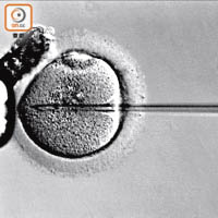 宮腔內人工授精是在女性排卵時，將活躍精子透過導管輸入女性宮腔內。（資料圖片）