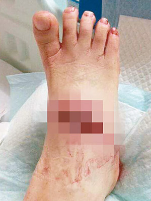 網上流傳相片，傷者腳背傷勢嚴重。（facebook「香港行山遠足之友（聊天吹水專區）」專頁）