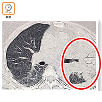 電腦掃描圖片顯示譚女士的左肺（紅圈示）被癌細胞侵襲。（中大提供）