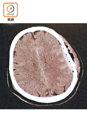 有傷者由樹上掉下，經腦部電腦掃描後，發現其頭骨凹陷。