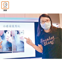 王小姐接受微波能量治療後，排汗量減七至八成。