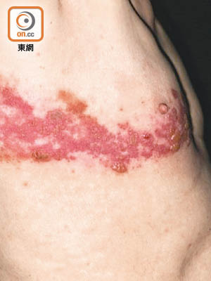 「生蛇」令身體出現紅疹並有劇烈刺痛。（資料圖片）