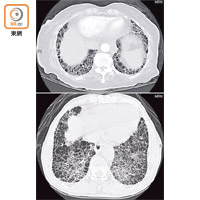 肺纖患者的肺部不斷結疤，變成蜂窩狀。（受訪者提供）