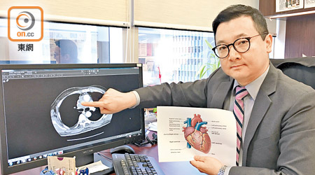 謝耀昌說，不少人確診上腔靜脈症候群後始發現患癌。（關琛詩攝）