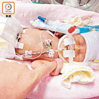 剛出生的諾呈躺在氧氣箱，維生儀器幾乎遮蓋了小臉蛋。