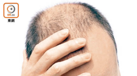 研究發現提早禿頭或提早有白髮的男士，出現心血管病的風險較健康人士高。